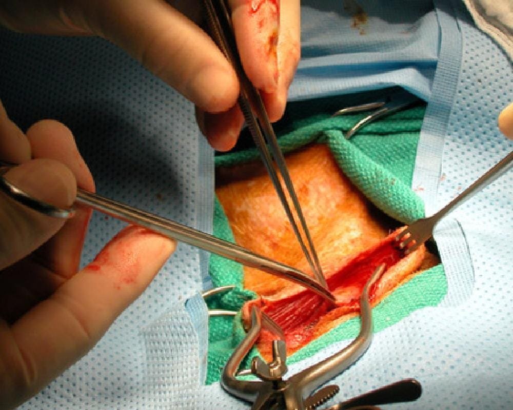 Peripheral Arterial Bypass Procedure
