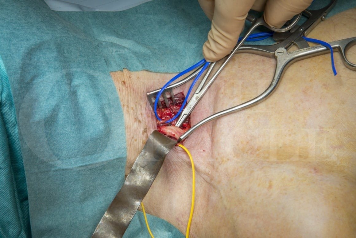 Thoracic Outlet Syndrome Diagram