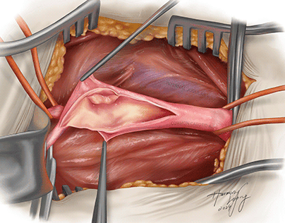 Peripheral Endarterectomy Procedure