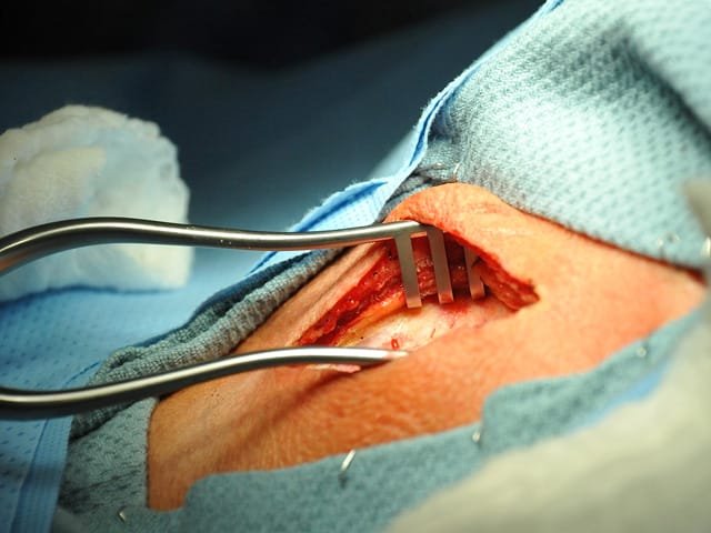 Peripheral Artery Disease Diagram