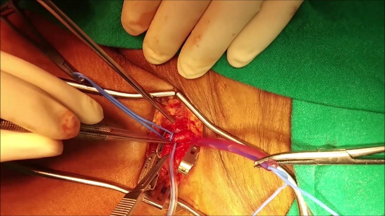 Blood Clot Removal Procedure