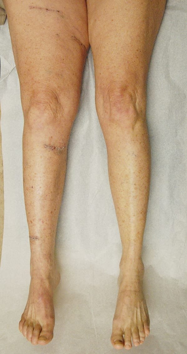 Lymphedema Surgery Procedure