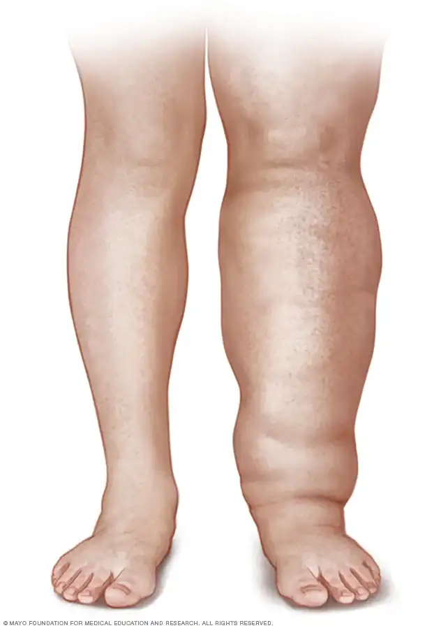 Lymphedema Diagram