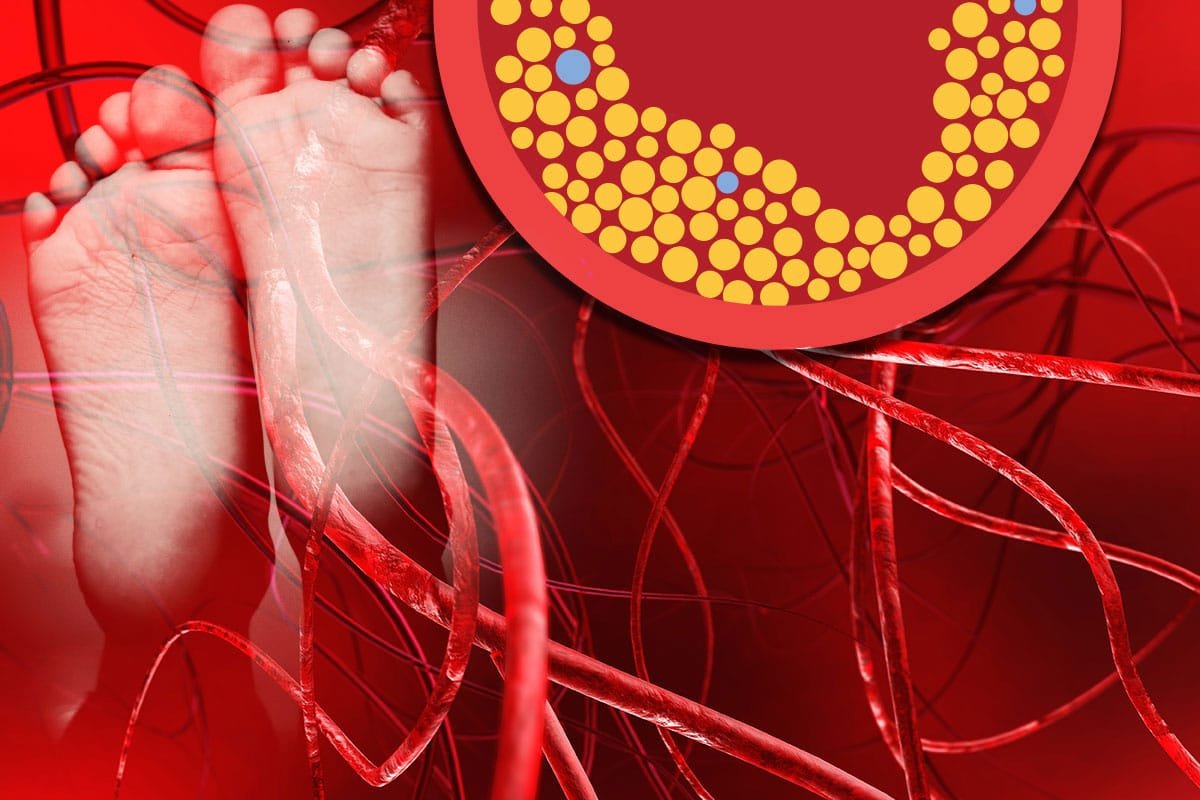 Peripheral Artery Disease Diagram