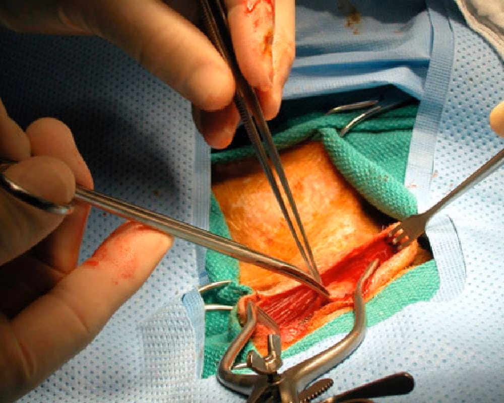 Peripheral Arterial Bypass Procedure