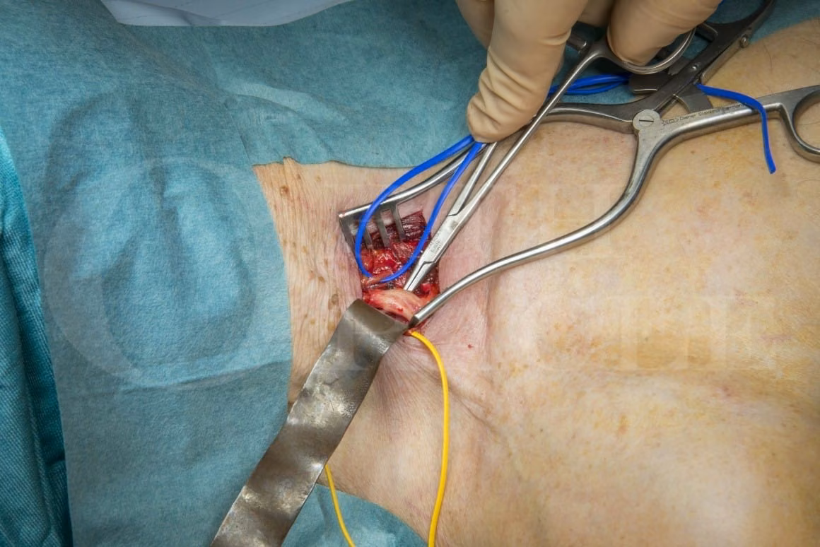 Thoracic Outlet Syndrome Diagram